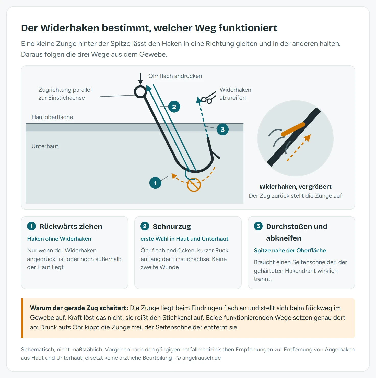 Schematischer Schnitt durch Haut und Unterhaut mit einem eingedrungenen Angelhaken. Der Haken tritt links durch die Hautoberfläche ein, der Bogen führt nach unten ins Gewebe, die Spitze mit dem aufgestellten Widerhaken zeigt schräg nach oben. Drei Wege sind eingezeichnet: Weg 1 als gestrichelter Pfeil gerade zurück nach oben, mit einem Sperrsymbol markiert, weil der Widerhaken sich dabei im Gewebe aufstellt. Weg 2 als Schnurzug: eine Schnurschlaufe liegt am tiefsten Punkt des Bogens, ein Finger drückt das Öhr flach auf die Haut, ein kräftiger Pfeil zeigt die Ruckrichtung parallel zur Einstichachse. Weg 3 als Durchstoßen: ein Pfeil folgt der Bogenkrümmung weiter nach oben durch die Haut, an der austretenden Spitze markiert eine Schere die Stelle zum Abkneifen des Widerhakens. Rechts eine Legende mit den drei Methoden und ihrer Eignung.
